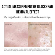 Facial blackhead suction device for acne removal

