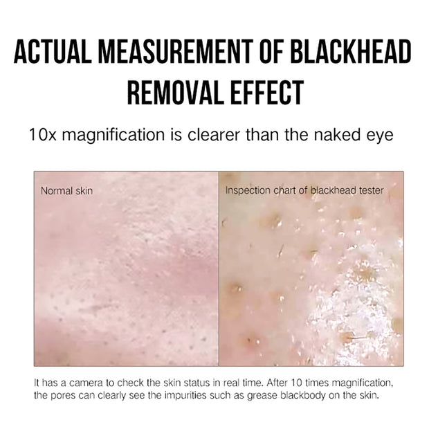 Facial blackhead suction device for acne removal

