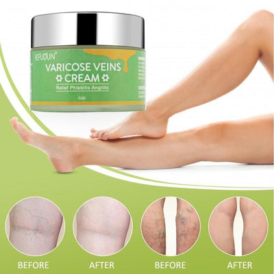 Varicose vein cream for leg pain and bulge relief

